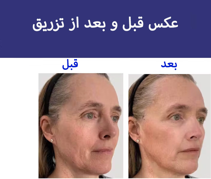 قبل-و-بعد-مزوژل--ملینا-بیوتی